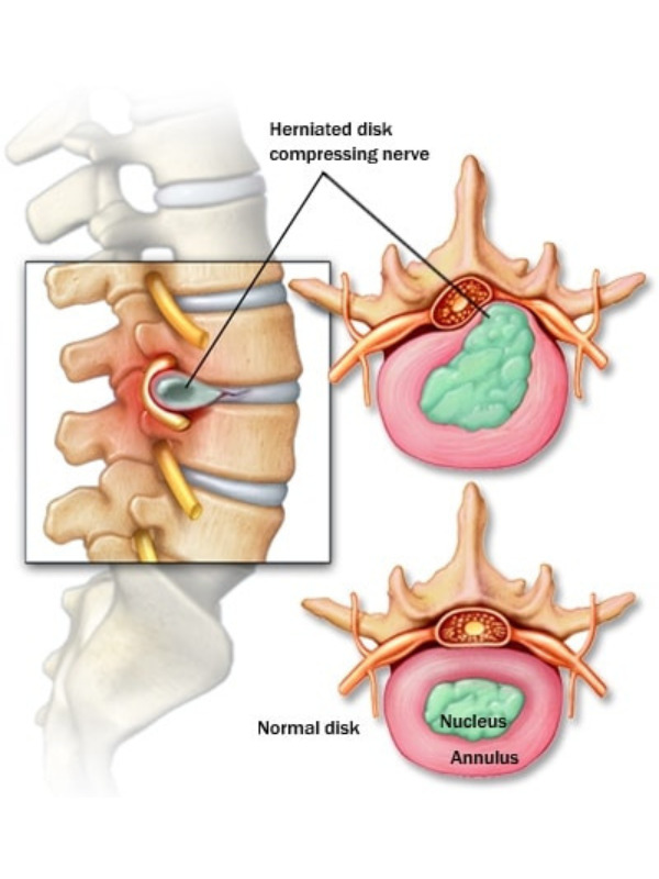 Herniated disc anatomy