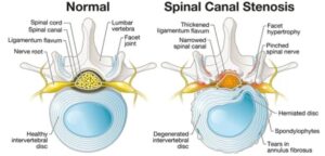 What is Spinal Stenosis and how can Spinal Decompression help